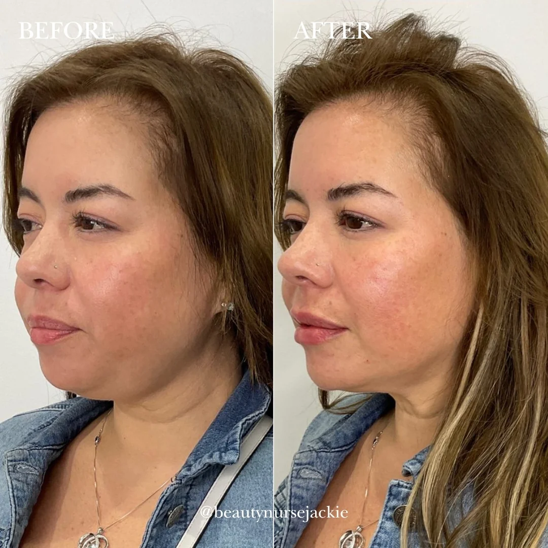 Full face rejuvenation 1b