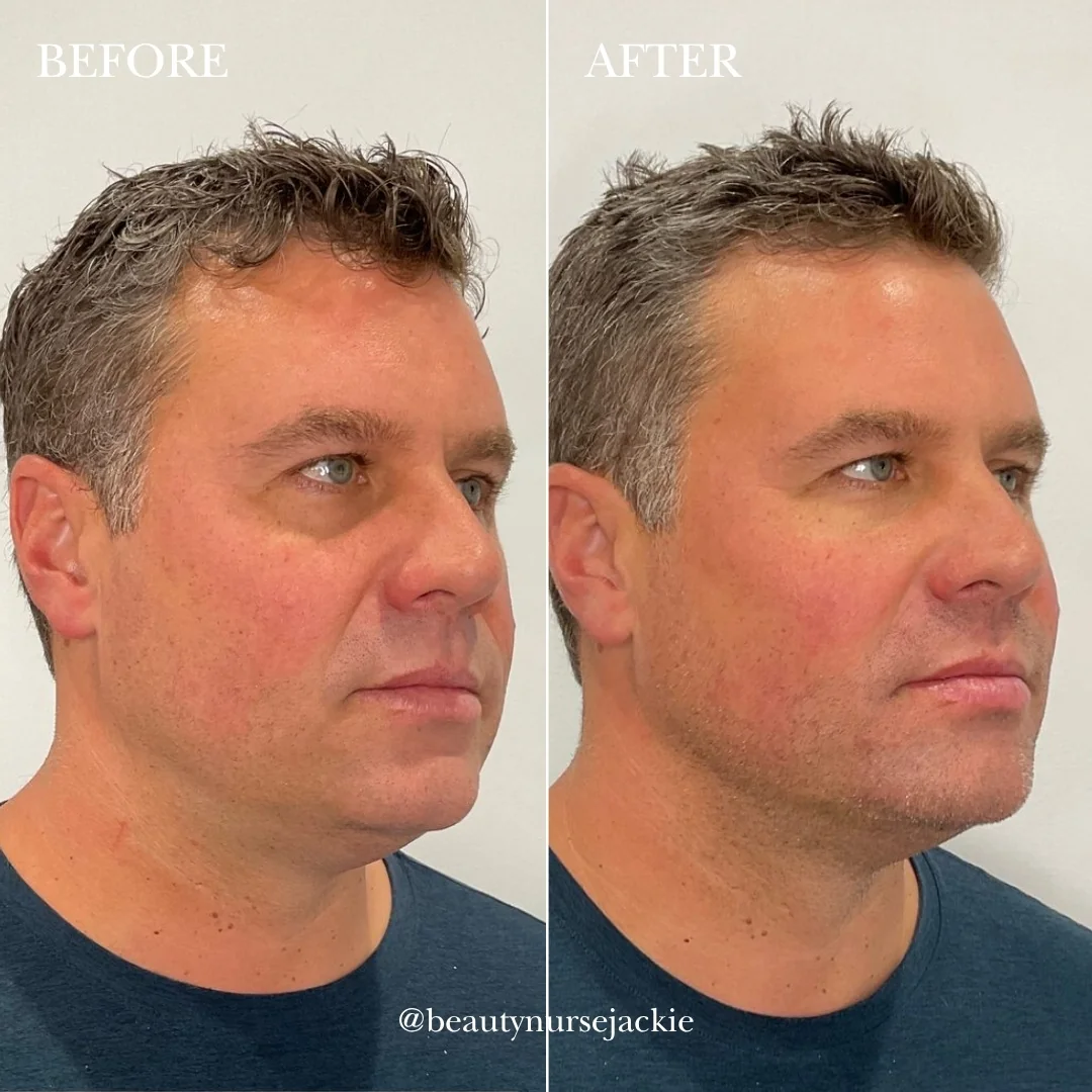 Jawline and under eye rejuvenation