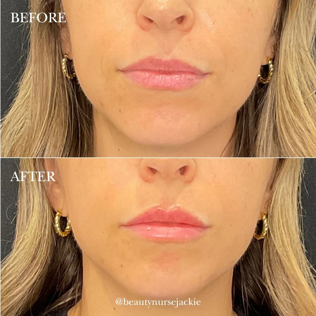 Lip and Chin balance