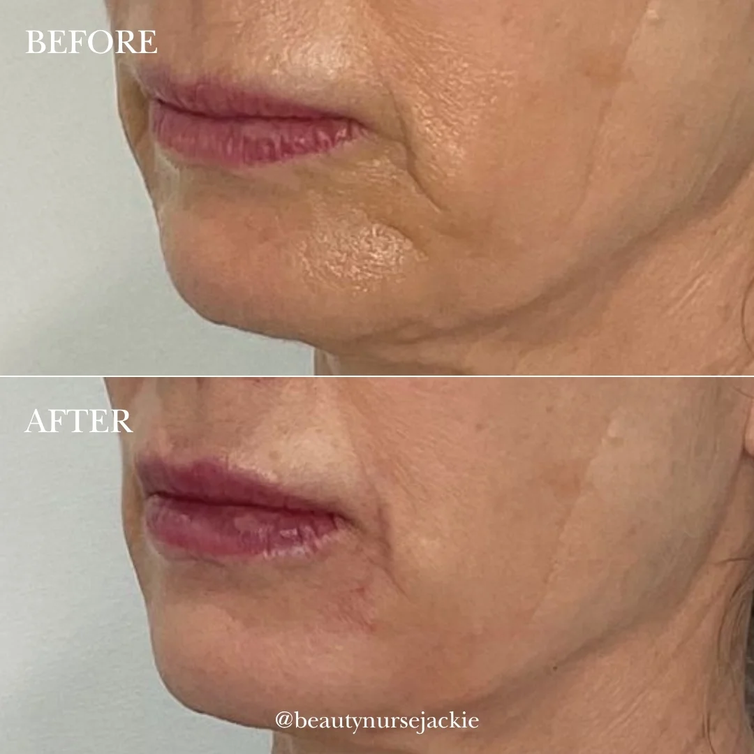 Lip and chin rejuvenation 1a