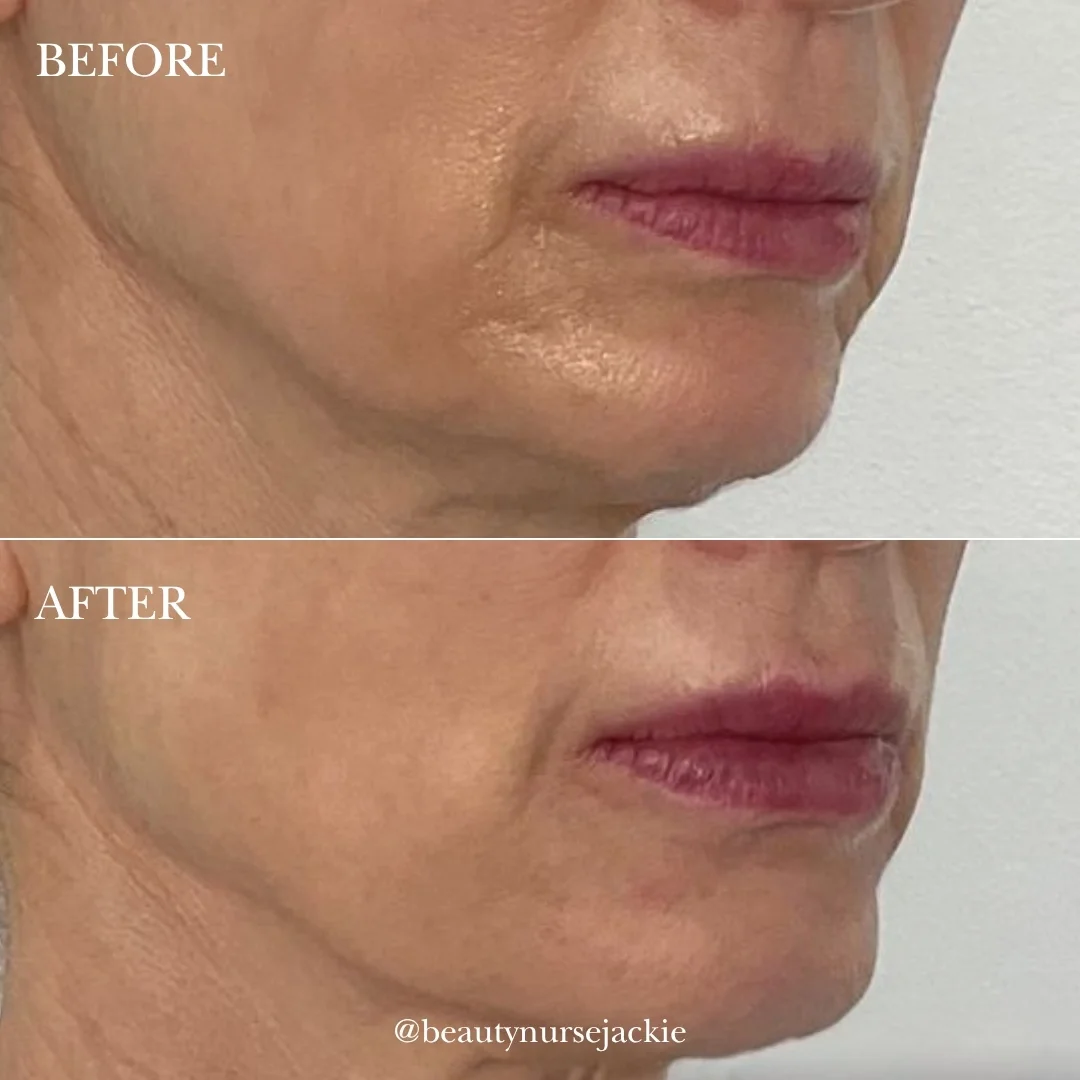 Lip and chin rejuvenation 1b