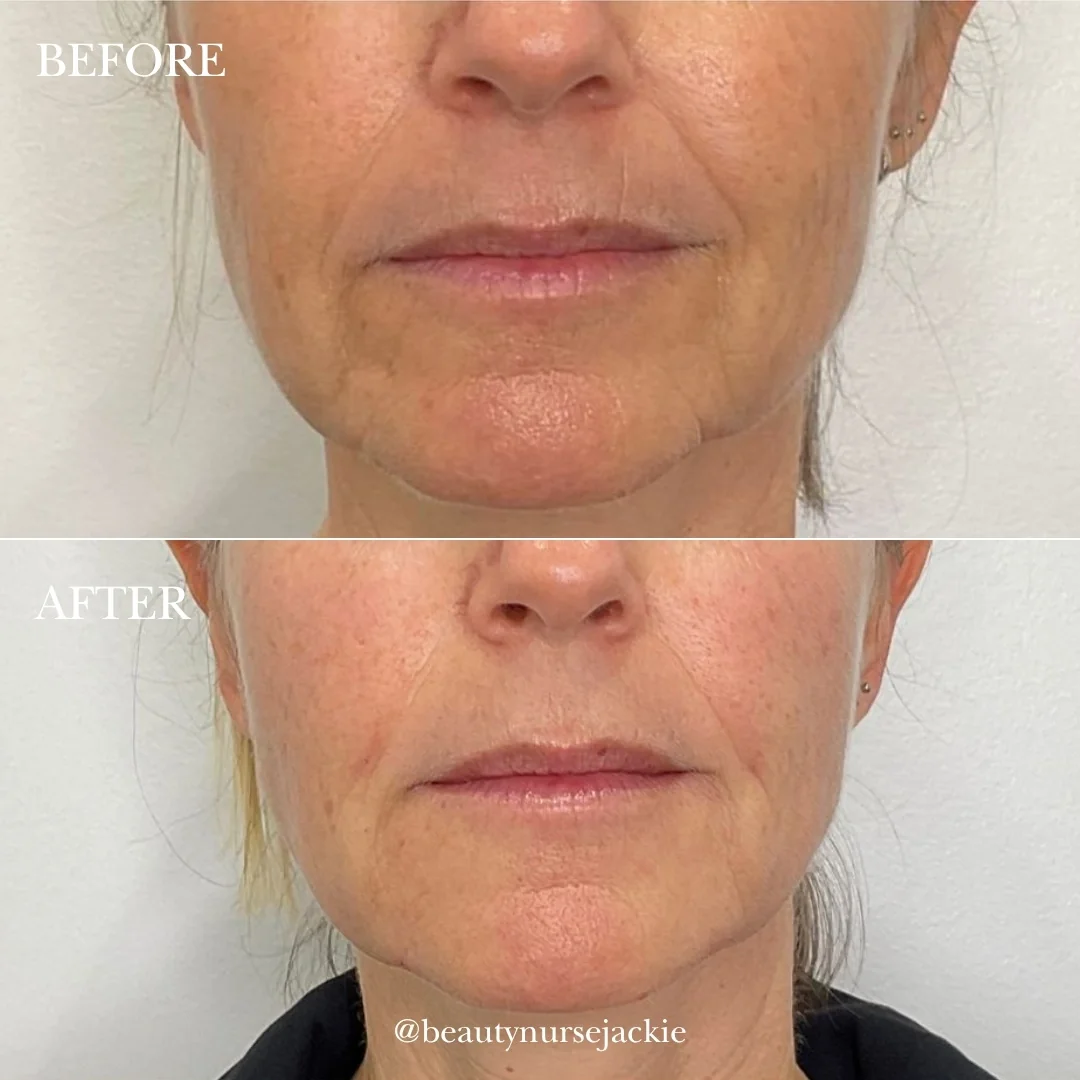Lip line removal and jowl rejuvenation 1a