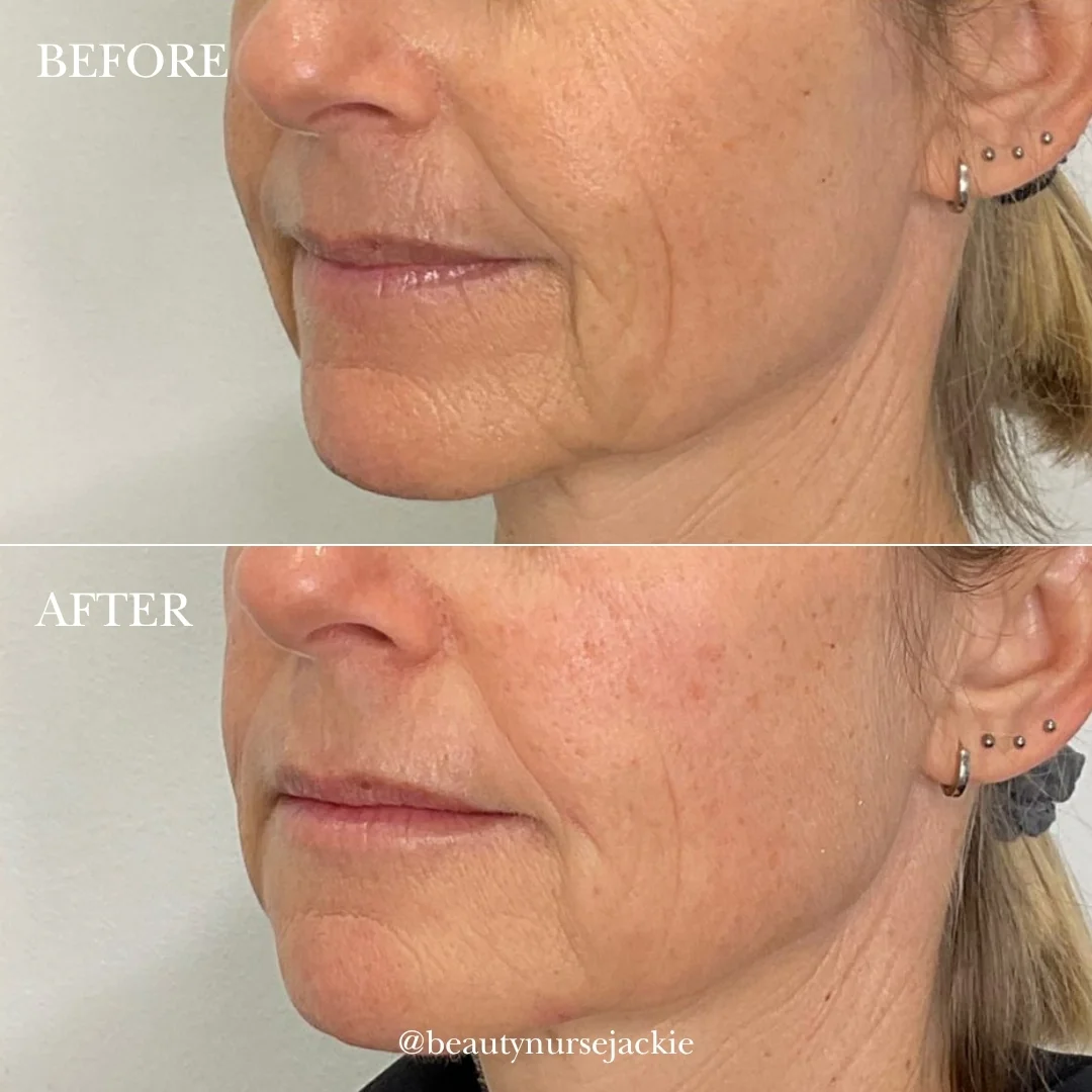 Lip line removal and jowl rejuvenation 1b