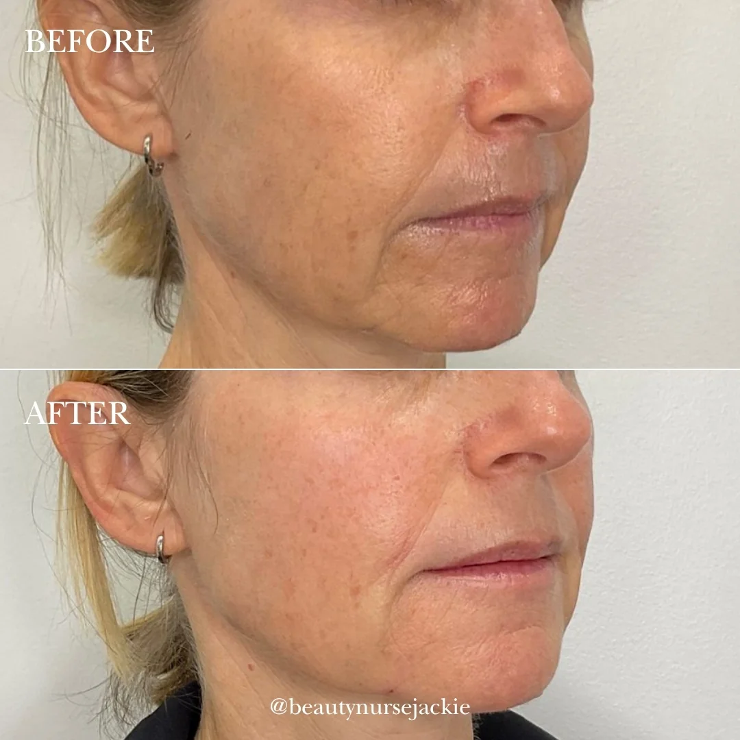 Lip line removal and jowl rejuvenation 1c
