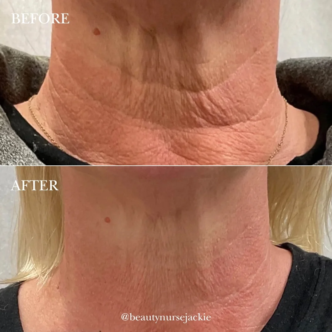 Neck makeover (wrinkle line botox)