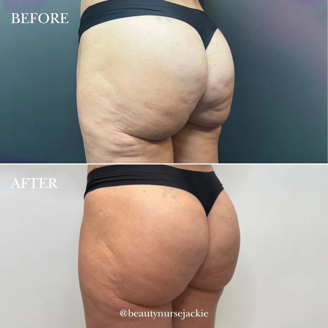 Non-surgical Bum Augmentation (no surgery Brazilian Butt Lift b&a)