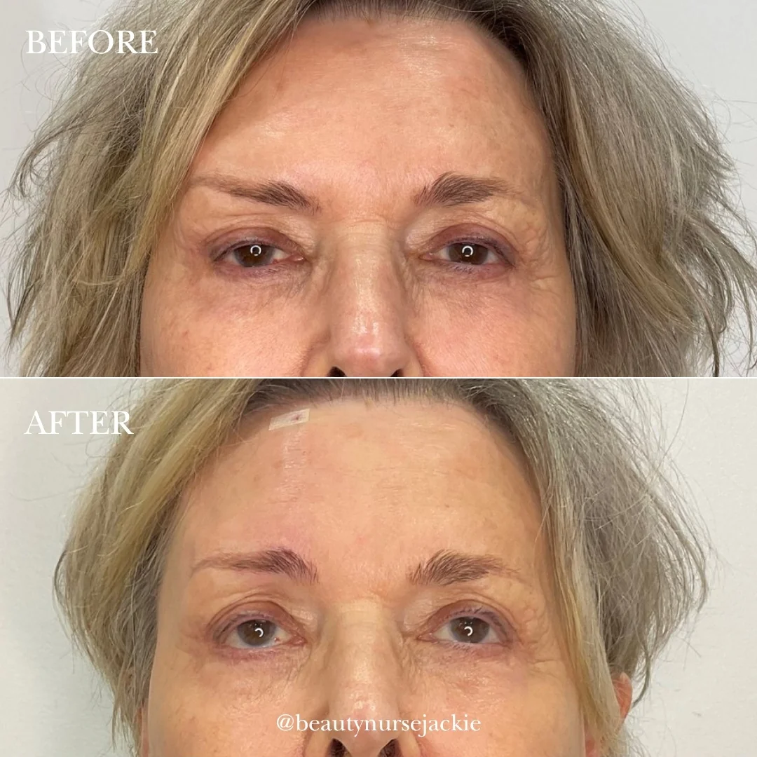 PDO thread lift for eye brow lift 1a