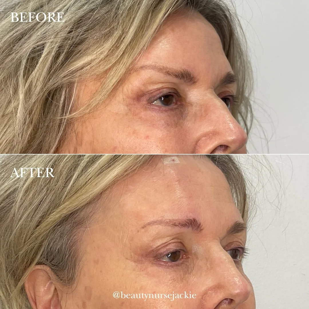 PDO thread lift for eye brow lift 1b