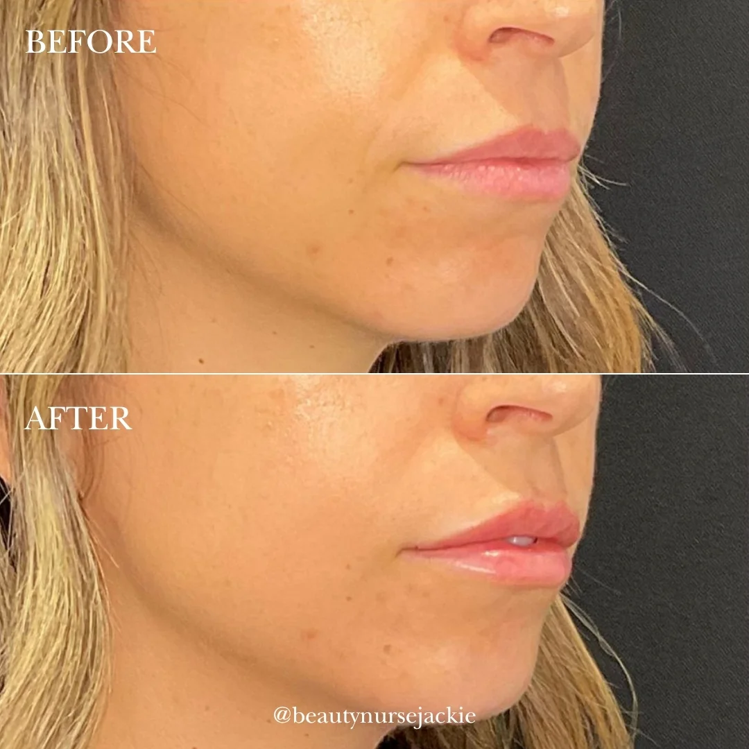 Subtle Profile projection for weak chin