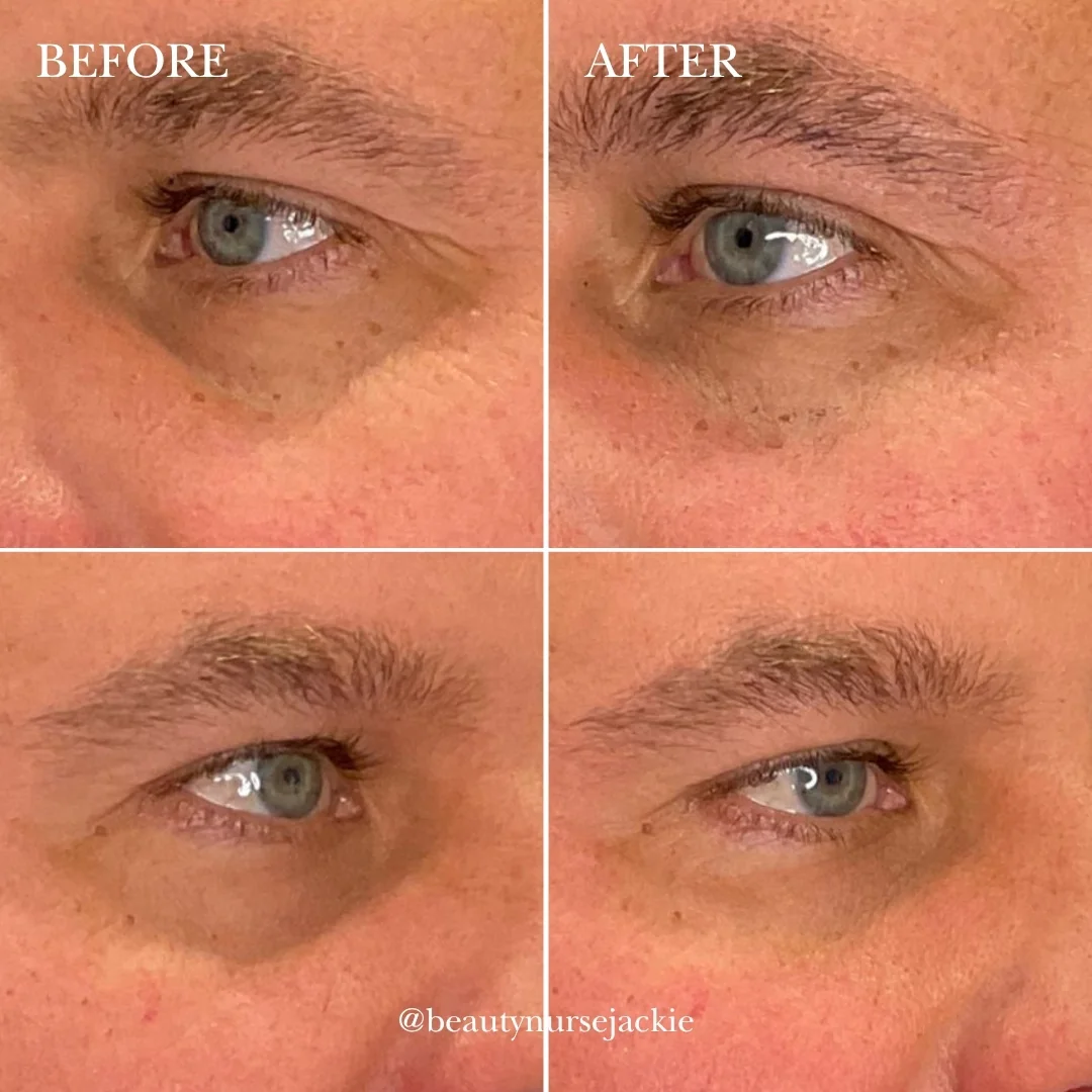 Under eye rejuvenation