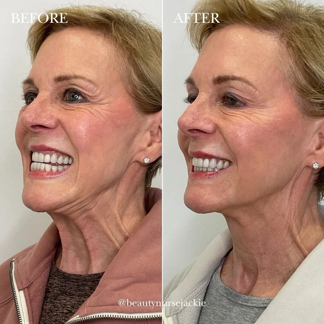 Platysmal band Botox c